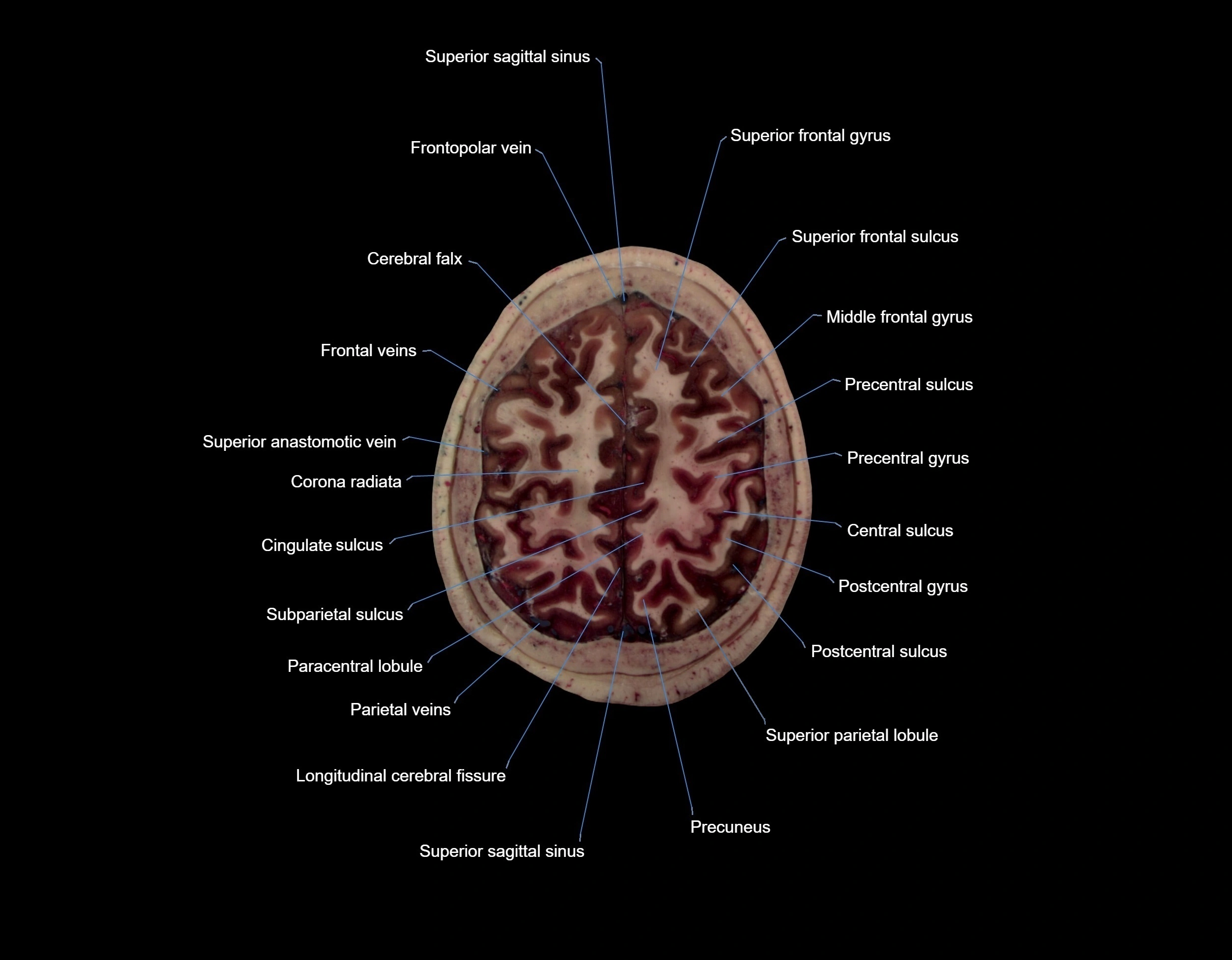 MRI Brain axial cross sectional radiology anatomy 3T image  -img-000063.webp